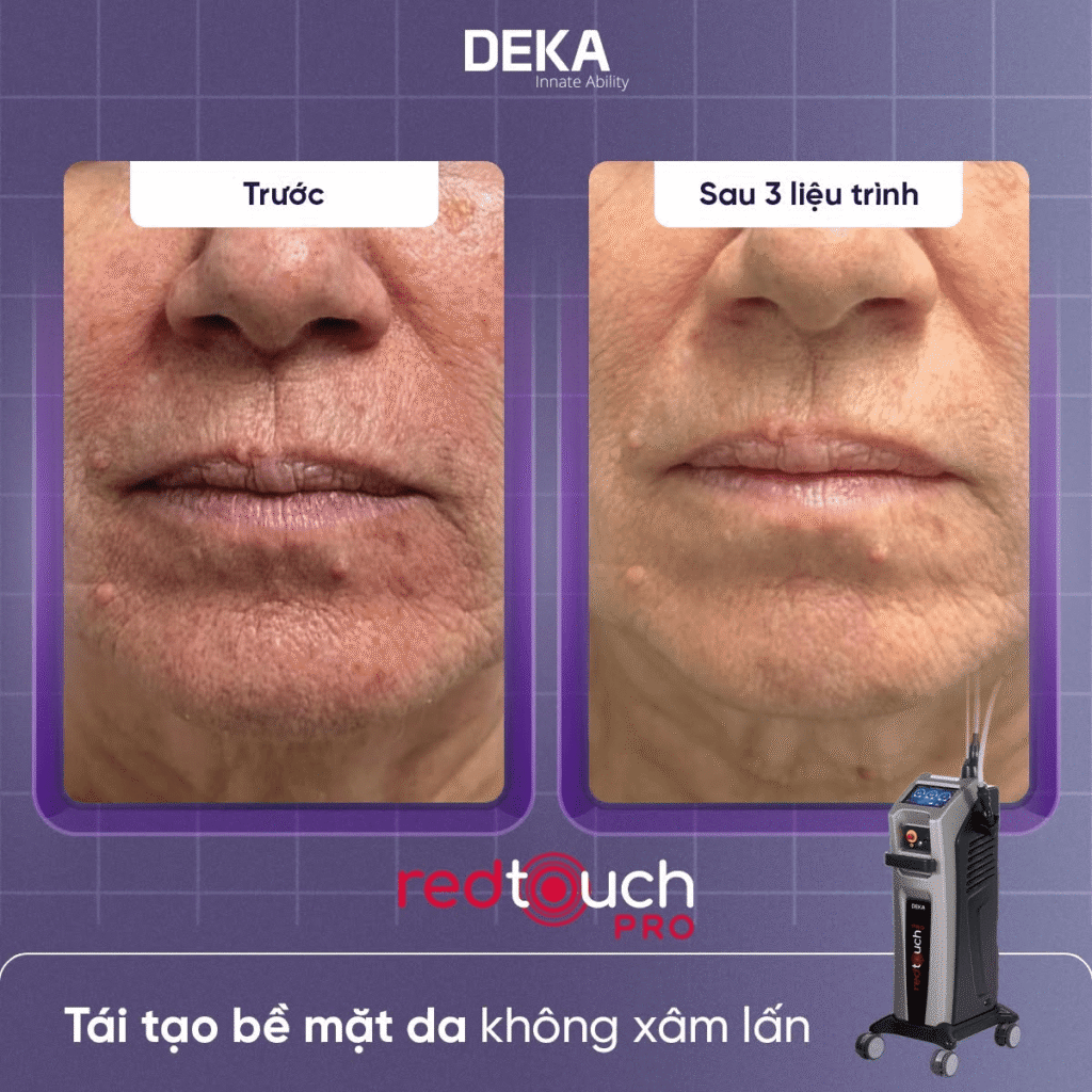 Collagen Banking là gì? Xu hướng & Phương pháp dự trữ Collagen cho làn da 10 Hình ảnh trước và sau liệu trình tái tạo bề mặt da với Redtouch Pro