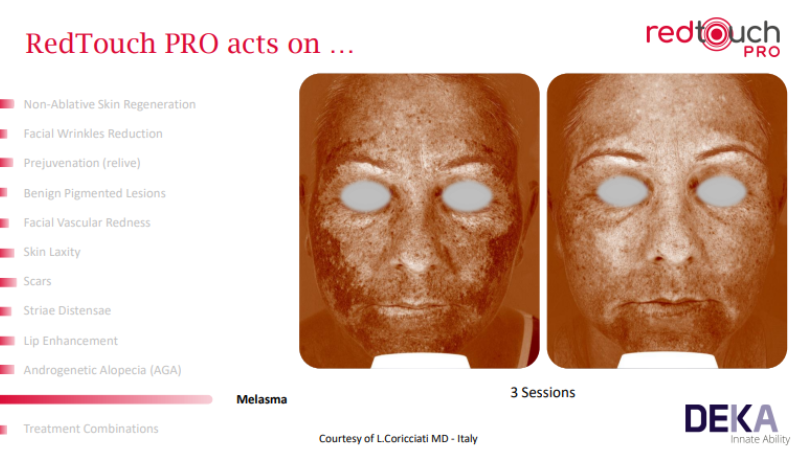 Redtouch Pro Là Gì? Tìm Hiểu Công Nghệ Trẻ Hóa Da Được Ưa Chuộng Tại Châu Âu 5 Ảnh so sánh Trước - Sau của bệnh nhân điều trị Nám mảng sau 3 buổi với RedTouch Pro