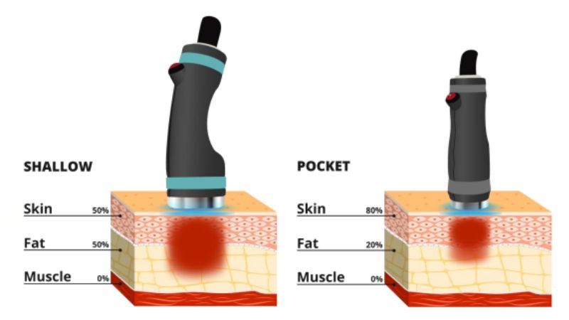 NGUYÊN NHÂN & GIẢI PHÁP GIẢM MỠ NỌNG CẰM HIỆU QUẢ 11 Đầu tay cầm Shallow & Pocket trong điều trị giảm mỡ