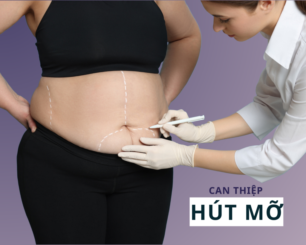 Hút mỡ là phương pháp can thiệp khi Cellulite mức độ nặng