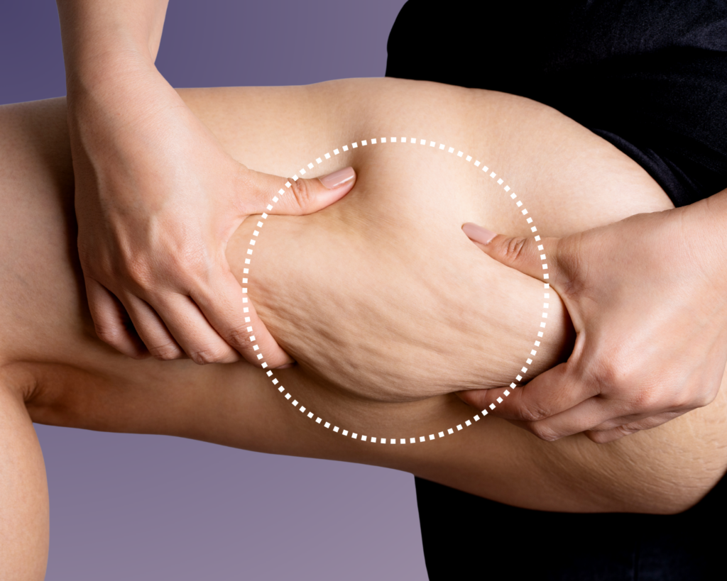 Cellulite là gì mà lại khiến nhiều chị em lo lắng về vóc dáng đến vậy?