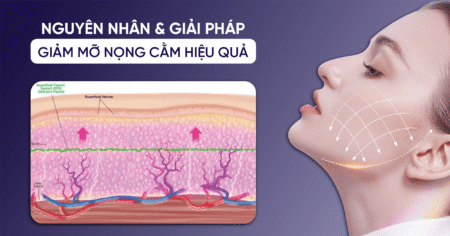NGUYÊN NHÂN & GIẢI PHÁP GIẢM MỠ NỌNG CẰM HIỆU QUẢ